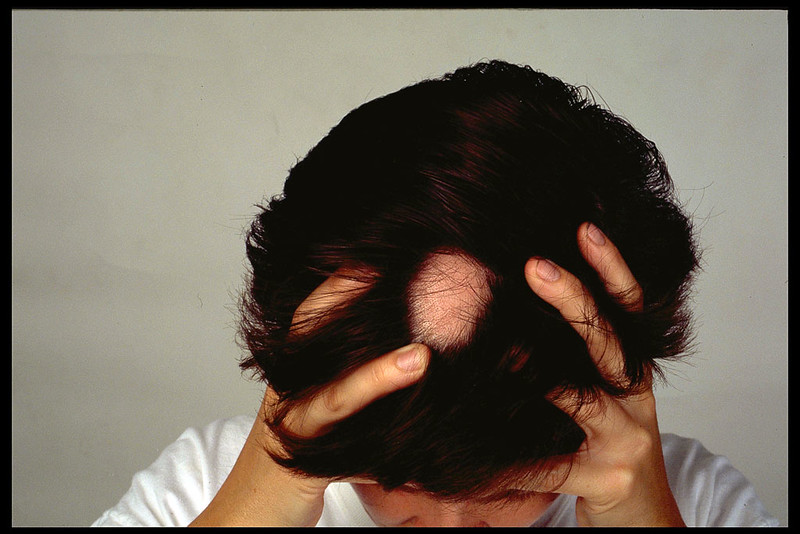 Sun Pharma Strikes $576M Deal to Get Hair Loss Drug to Rival Lilly, Pfizer Meds