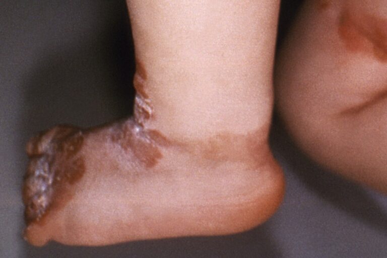 FDA Approves First Drug for Rare Skin Disorder, and It's a Redosable Gene Therapy