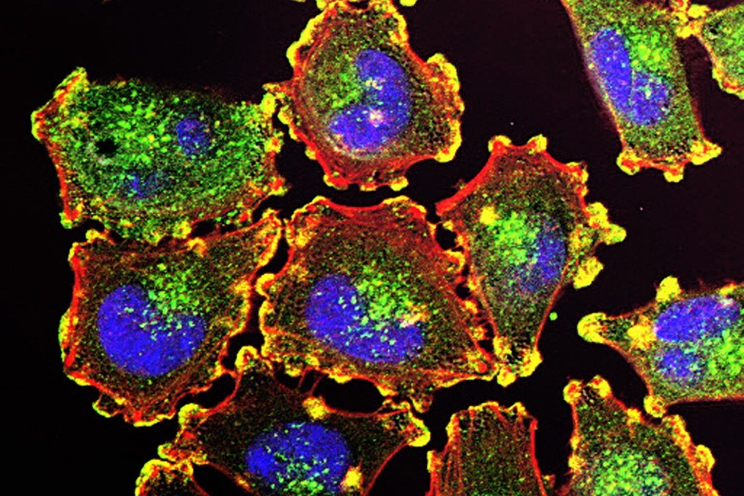 Bristol Myers Squibb Cancer Immunotherapy Flunks a Key Test in Melanoma